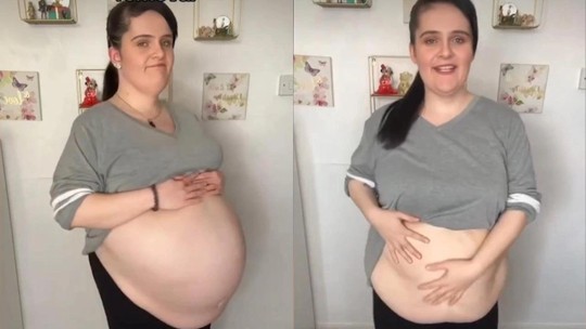 Mulher mostra antes e depois após retirar cisto de 15 quilos: "Pensavam que eu estava grávida"