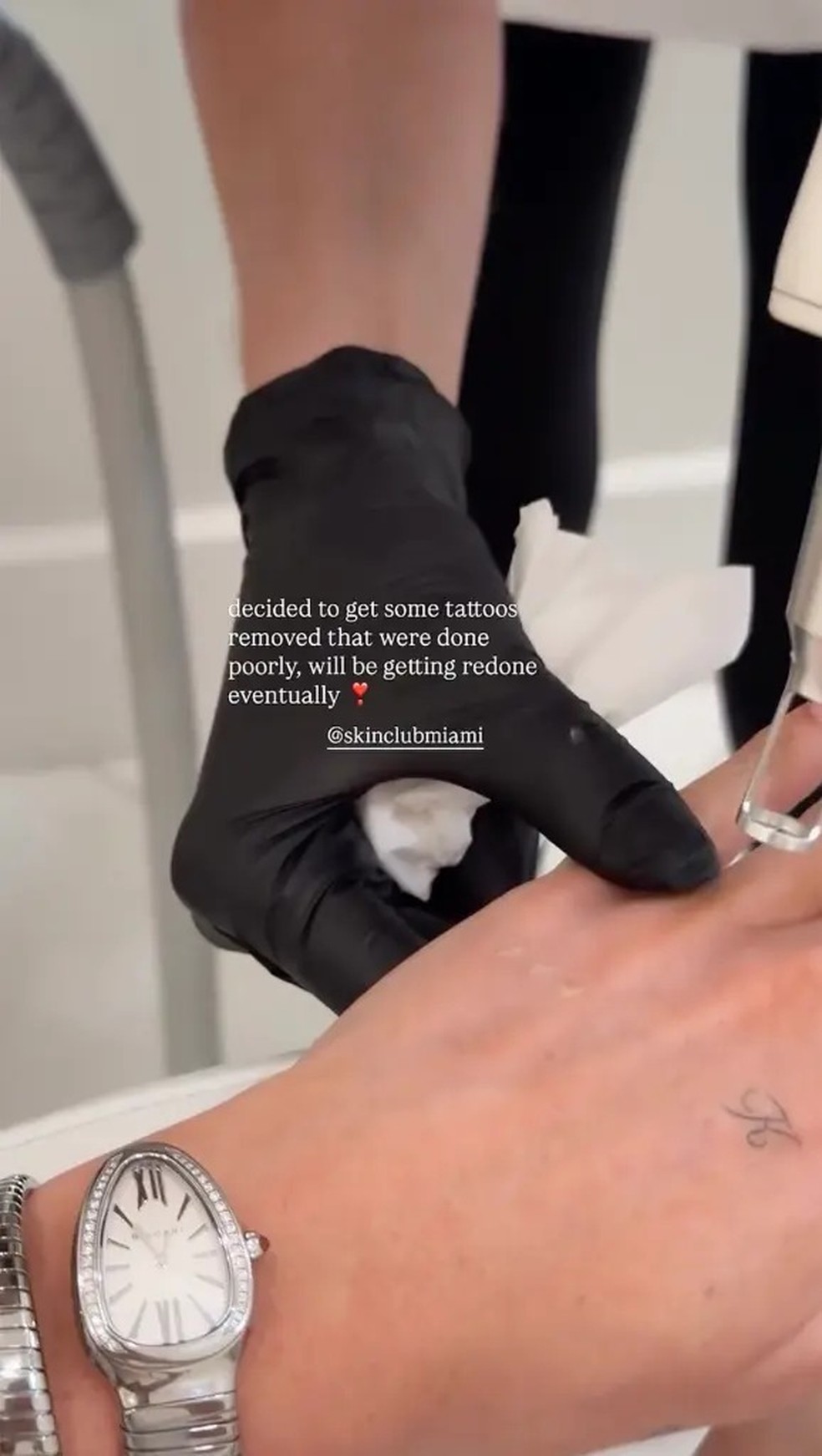 Kate Cassidy remove tatuagem feita em homenagem a Liam Payne — Foto: Reprodução/Instagram